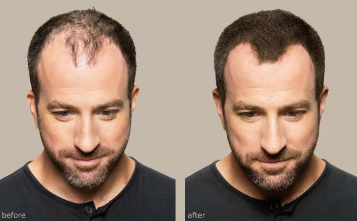 Balding man before and after concealing scalp show-through